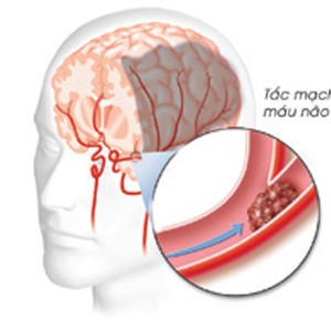 Những nguyên nhân chủ yếu của thiếu máu não?