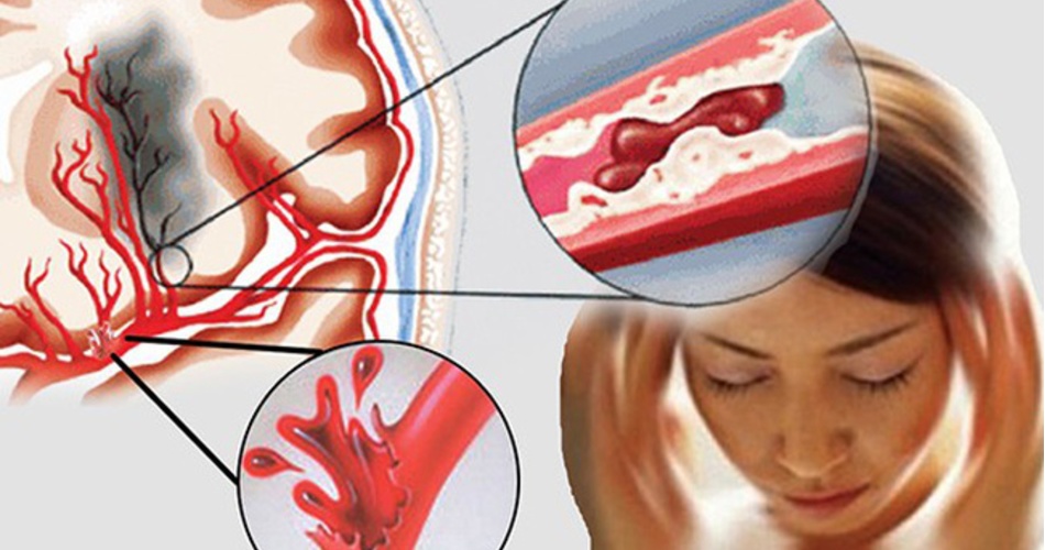 Thiếu máu não gây đột quỵ